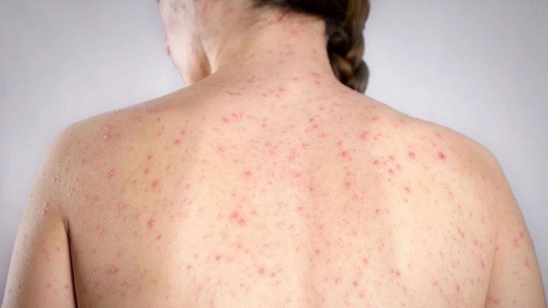 Sarampión: cuatro brotes activos y 500 casos bajo investigación