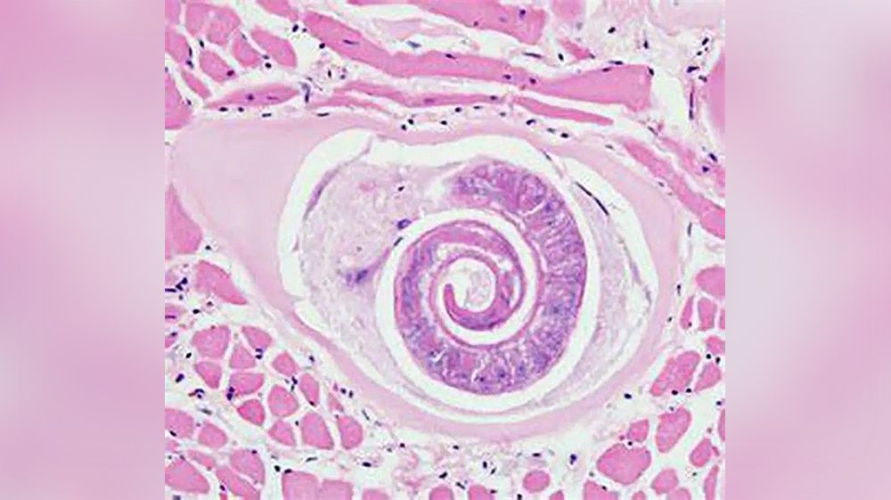 Triquinosis: Continúa la búsqueda del foco de contagio